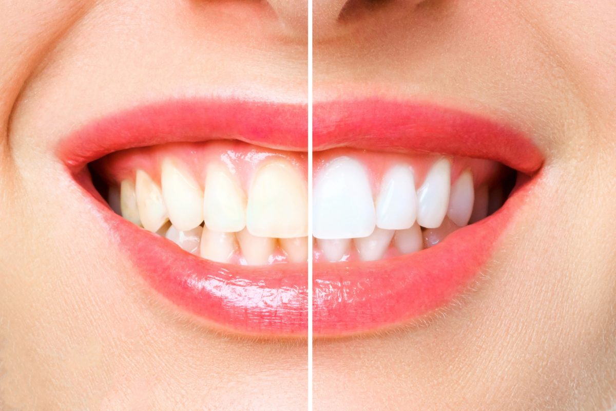 Complete Whitening